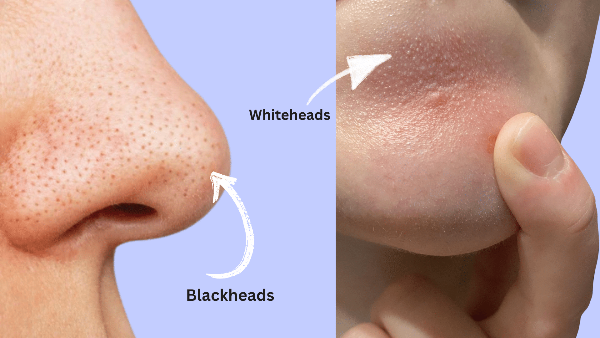 the difference between whiteheads vs blackheads