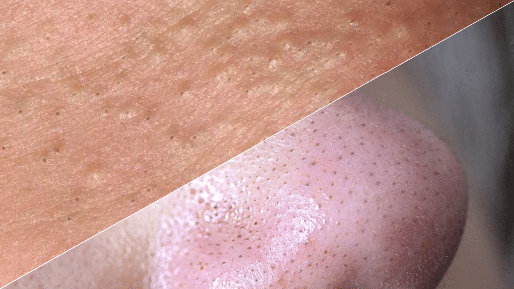 What are the Differences Between Whiteheads vs Blackheads?