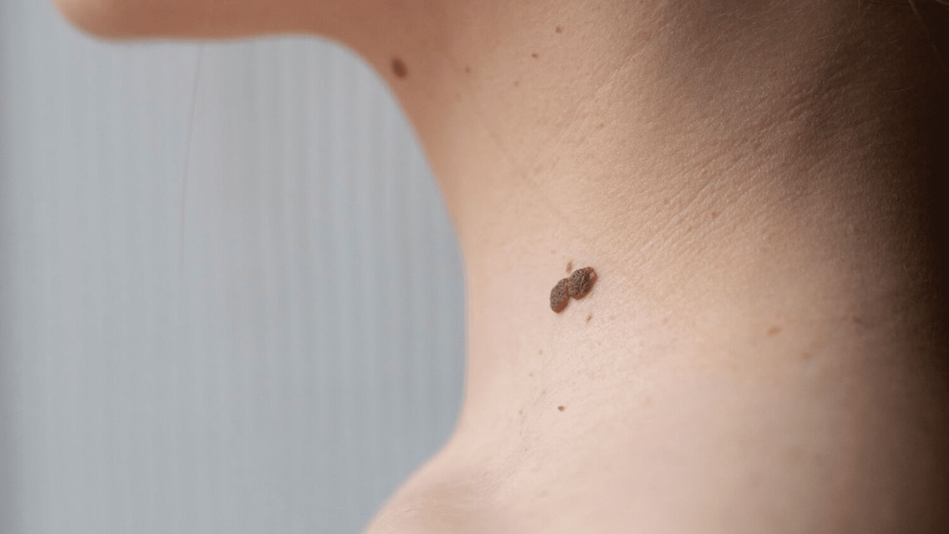 how to remove skin tags in one night