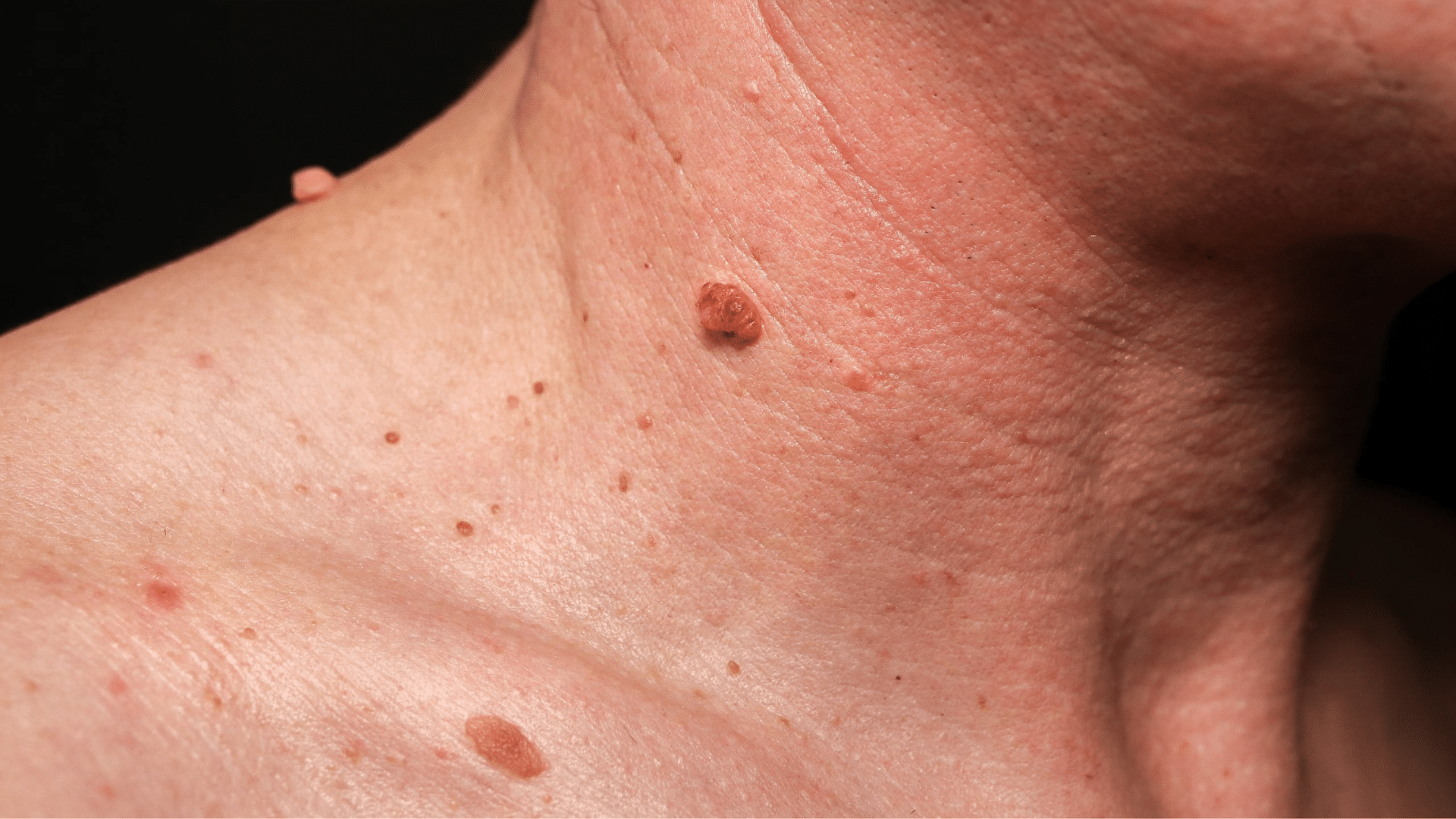 Risks Associated with Skin Tags