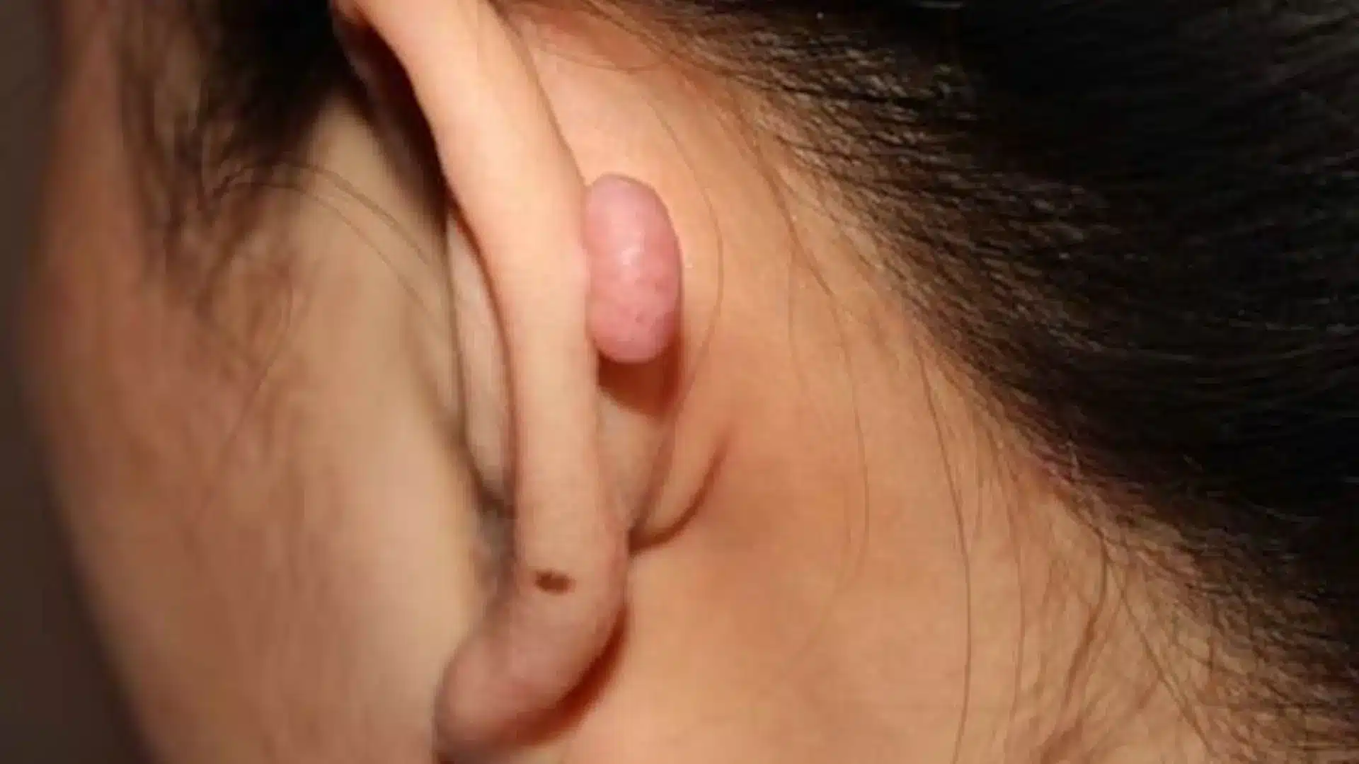 Close-up of a person's ear showing a small, pink, raised growth on the helix.