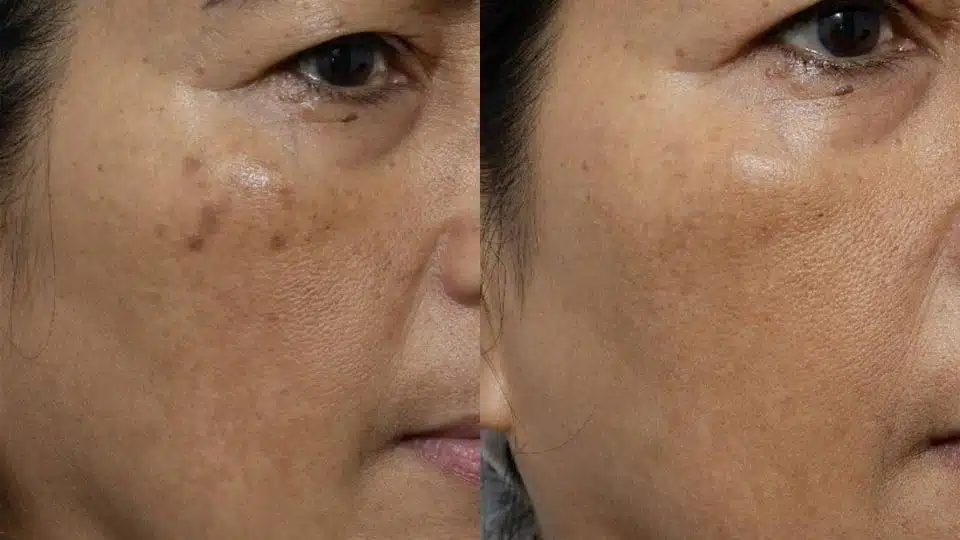 Before and after close up of a womans cheek showing faded melasma and a more even skin tone after treatment