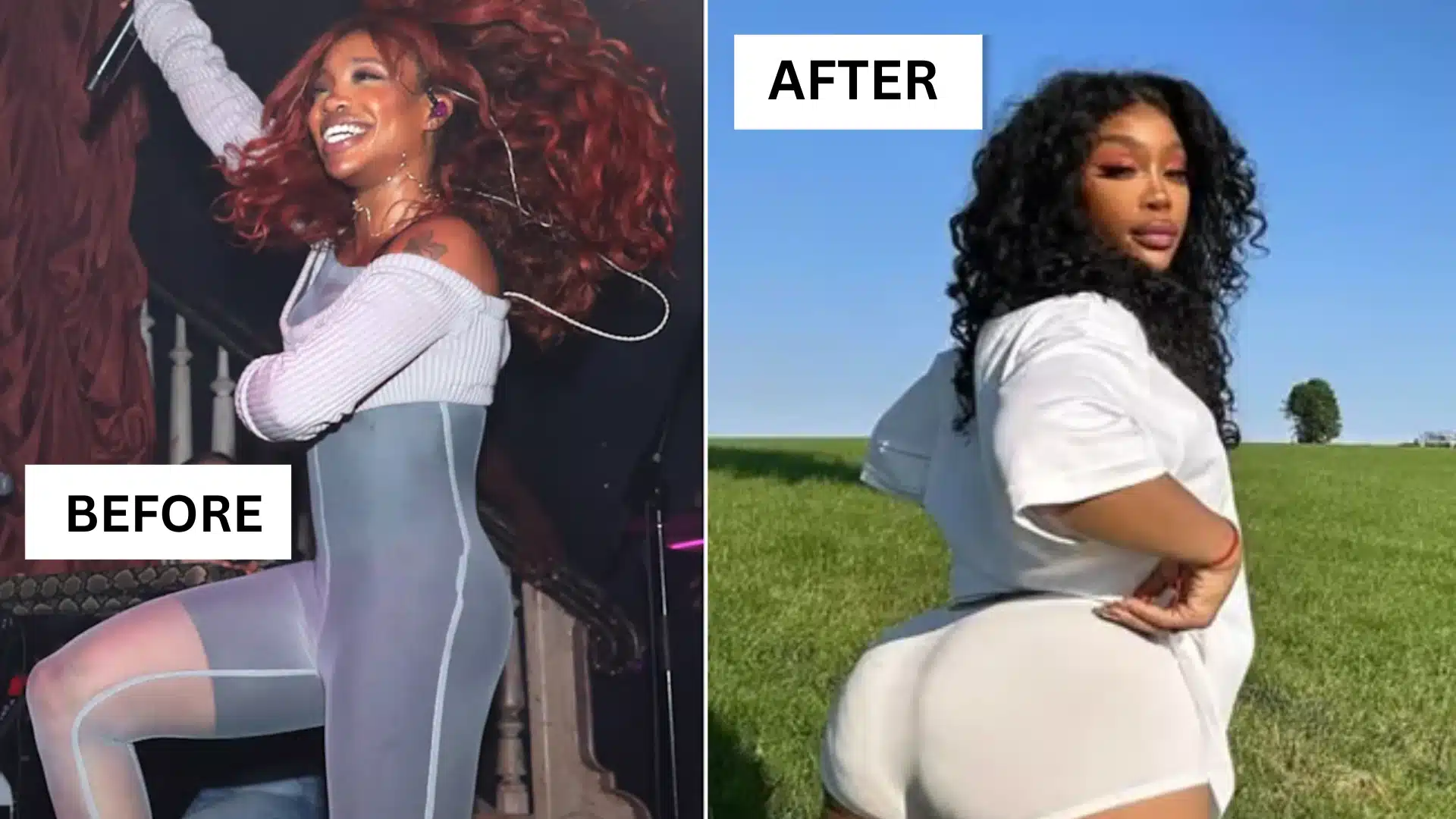 Comparioson of SZA before and after butt lift operation.