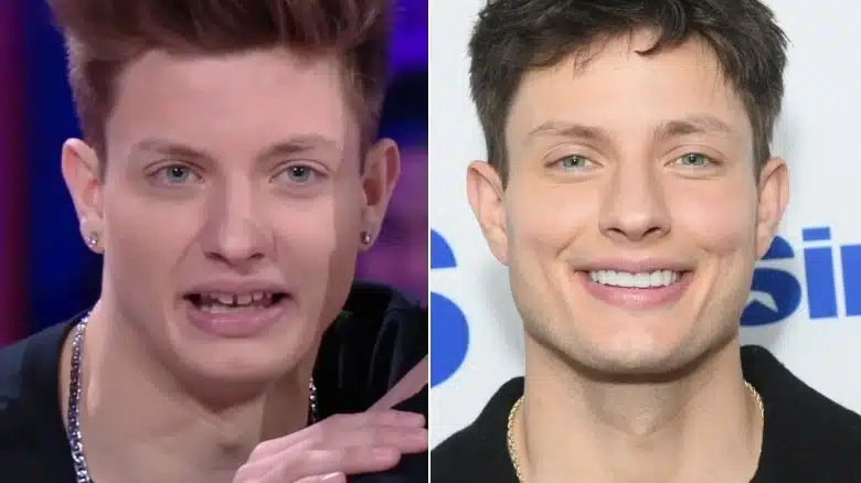 image shows the comparison between matt rife teeth and jaw over the years