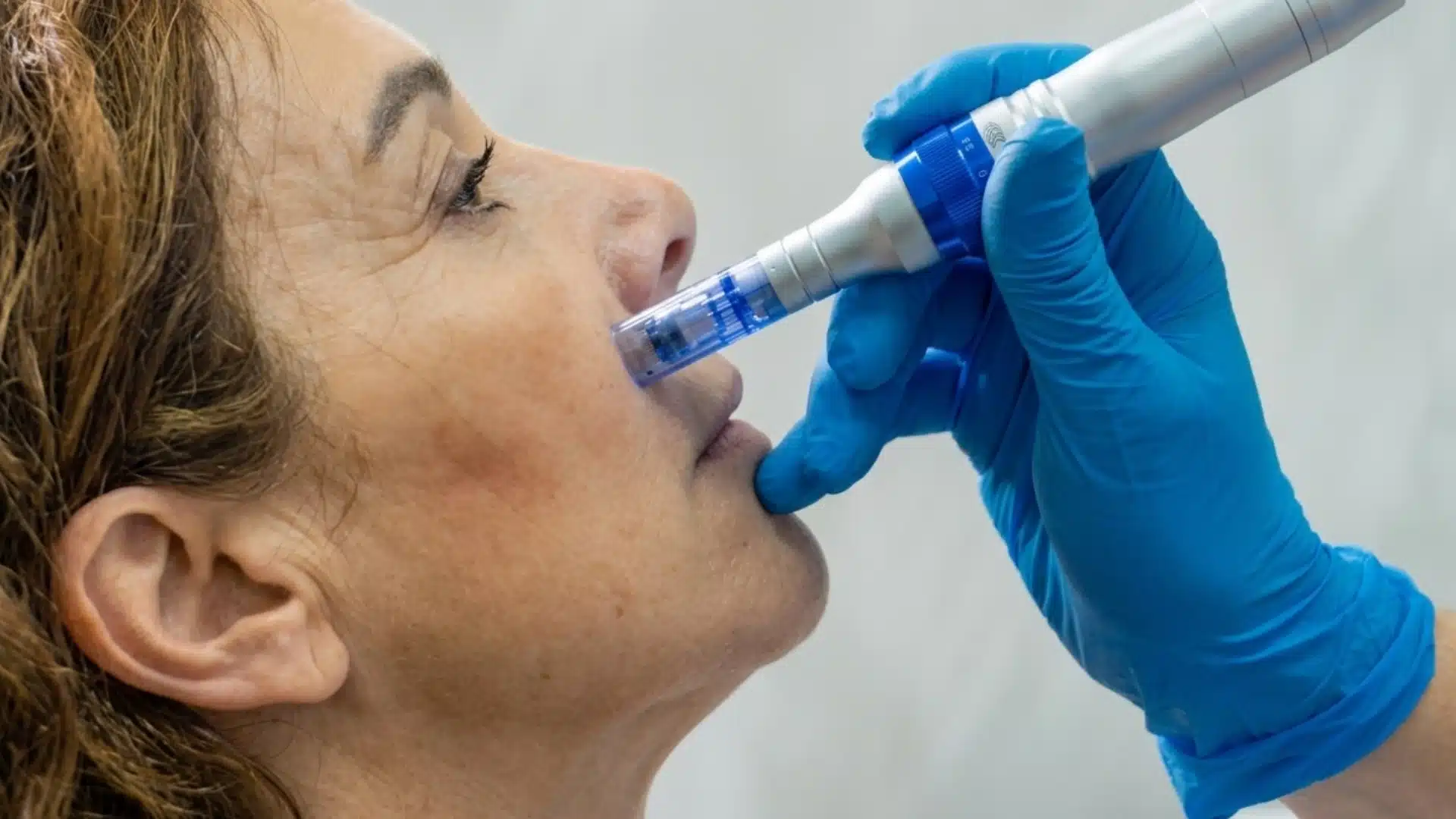 A woman just simply lying and dermantologist performing the microneedling session.